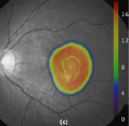 Simulated dose mapping using polycapillary optic for the treatment of macular degeneration.